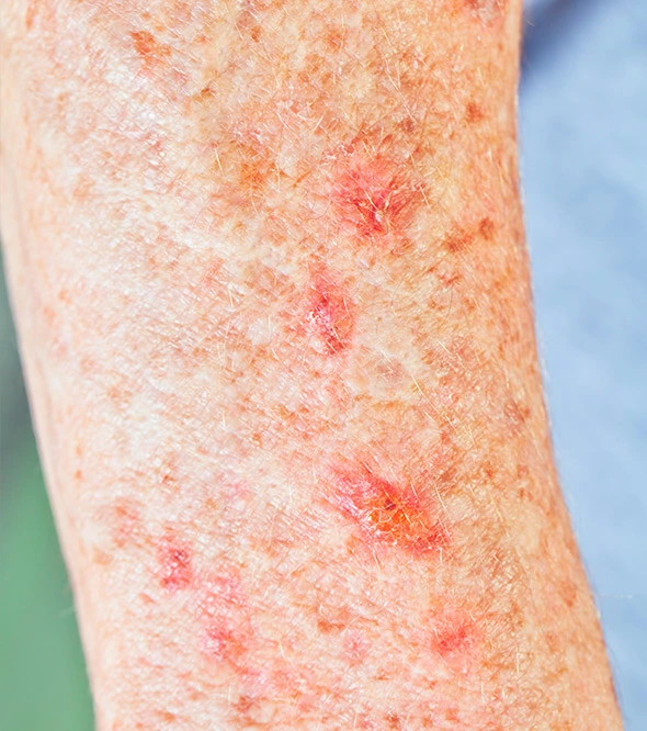 Actinic-Keratosis-01