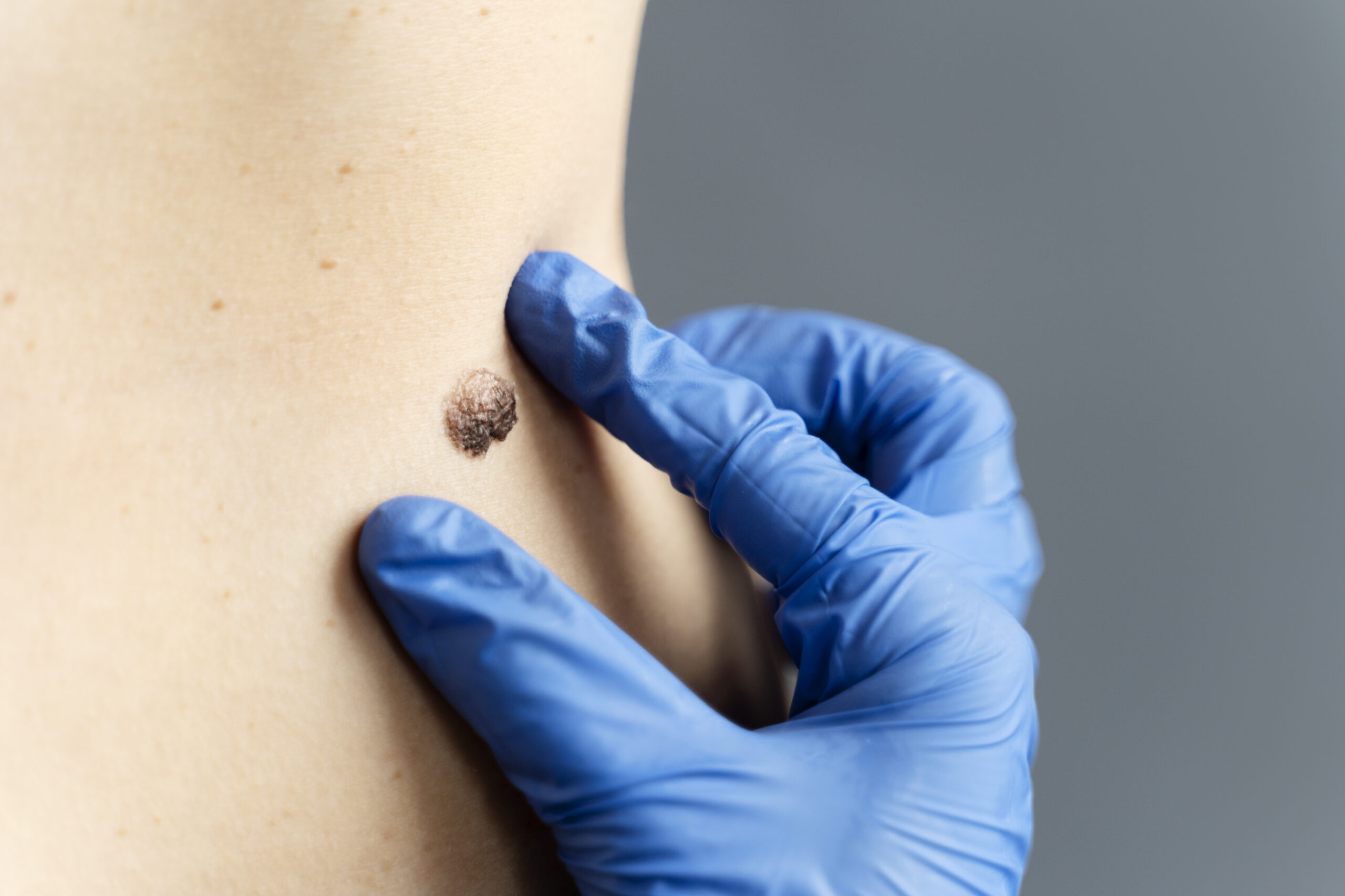 close-up-hand-with-glove-measuring-mole