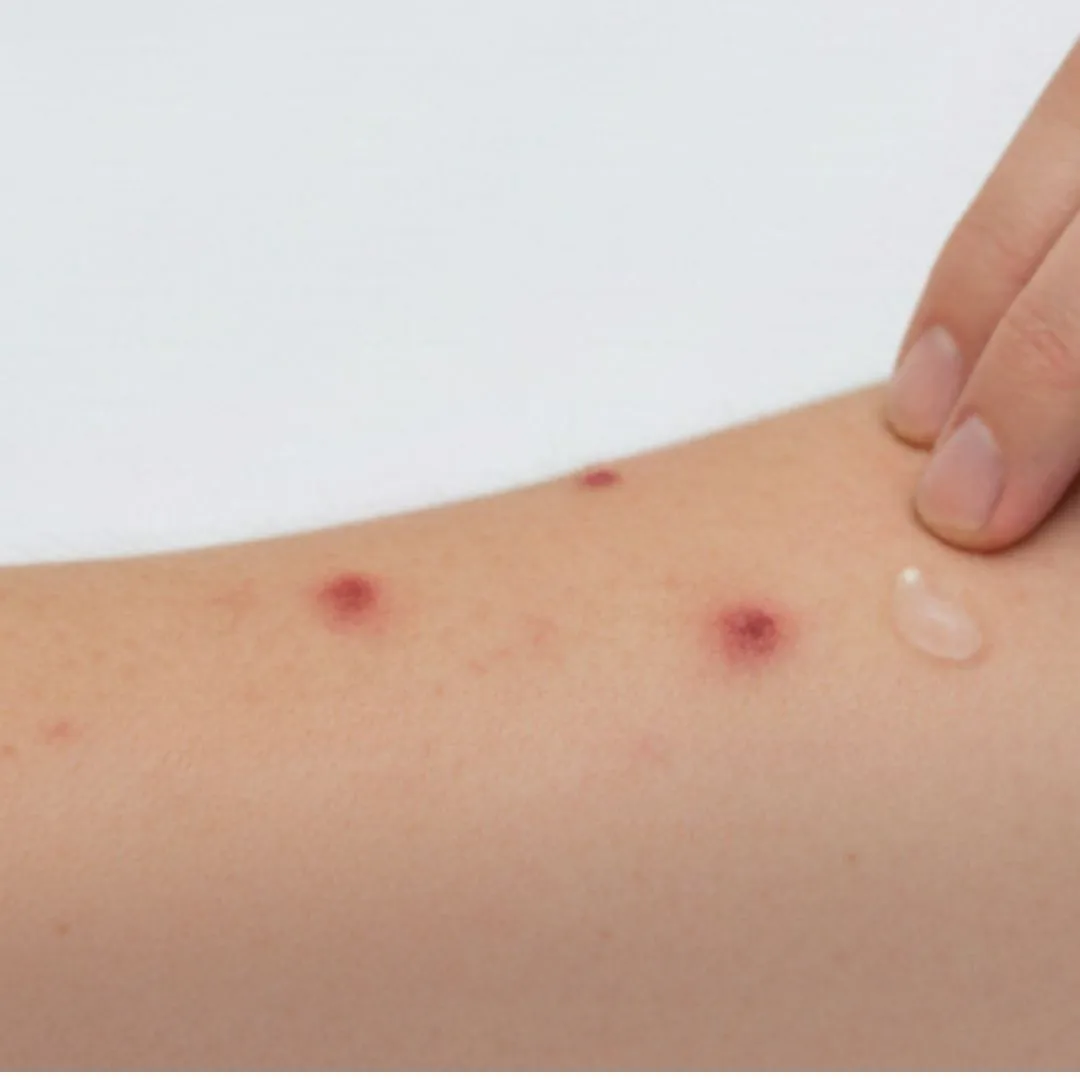 Topical Antimetabolite Creams Topical Antimetabolite Creams