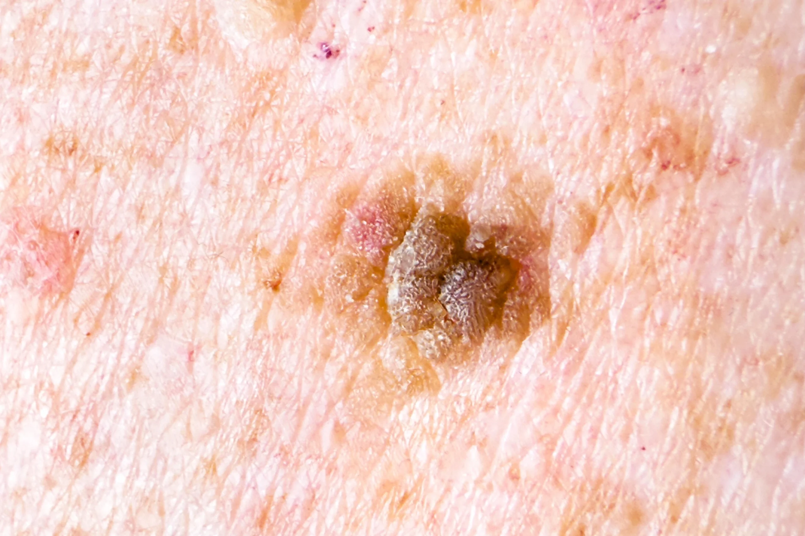 Skin Cancer Check Canberra