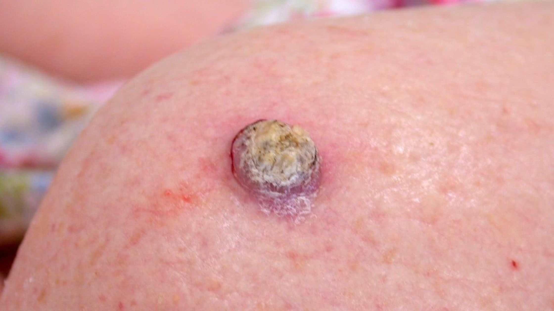 squamous cell skin cancer treatment