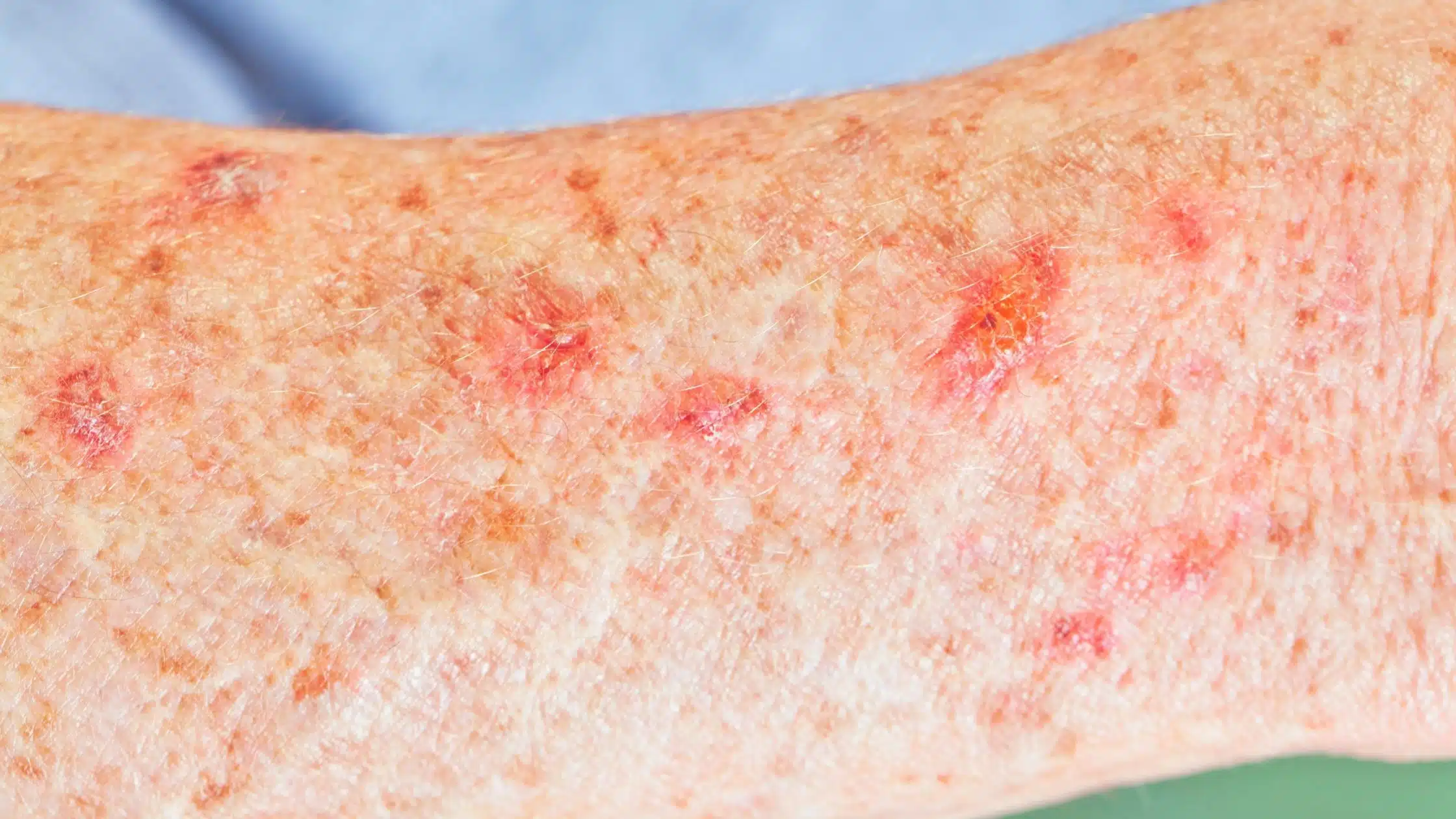 Solar Keratoses (Sun Spots) in Canberra