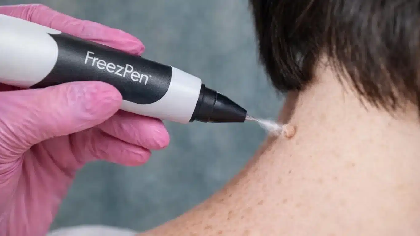 Cryotherapy for Skin Lesions in Canberra